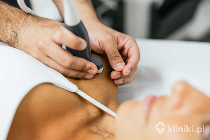 Dry needling może pomagać w zmniejszeniu napięcia mięśniowego i dolegliwości bólowych Dry needling może pomagać w zmniejszeniu napięcia mięśniowego i dolegliwości bólowych