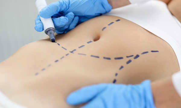 Liposukcja okolicy brzucha daje trwalsze efekty przy utrzymaniu stabilnej masy ciała i zdrowego stylu życia