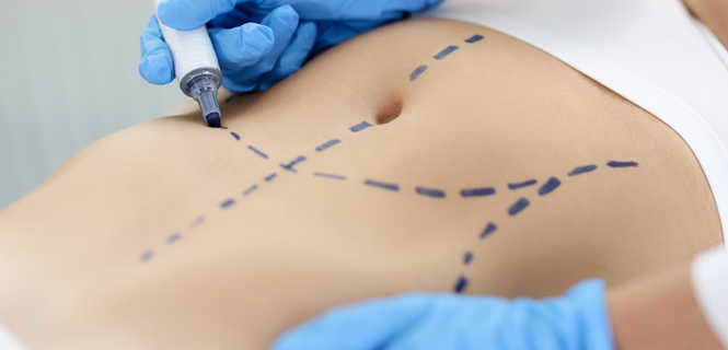 Liposukcja brzucha – skuteczna metoda modelowania sylwetki