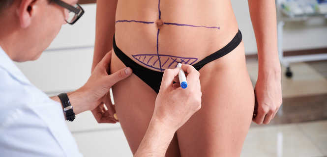 Liposukcja SmartLipo - wszystko co musisz wiedzieć