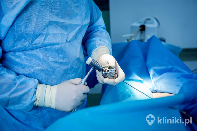 Mikrodiscektomia usuwa fragment dysku uciskający korzeń nerwowy