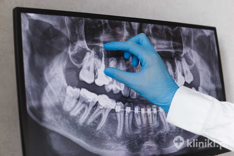 Ponowne leczenie kanałowe wymaga dokładnej diagnostyki i oceny stanu zęba Ponowne leczenie kanałowe wymaga dokładnej diagnostyki i oceny stanu zęba