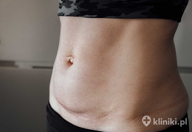 Leczenie endometriozy powłok brzusznych może wymagać wycięcia fragmentu zajętych tkanek Leczenie endometriozy powłok brzusznych może wymagać wycięcia fragmentu zajętych tkanek