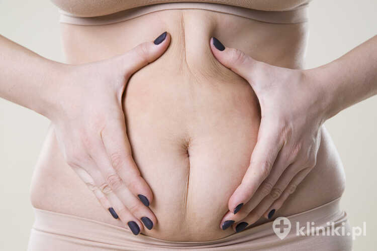 Liposukcja brzucha pozwala usunąć miejscowe nagromadzenia tłuszczu podskórnego