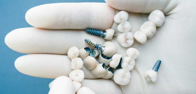 Rodzaje implantów stomatologicznych
