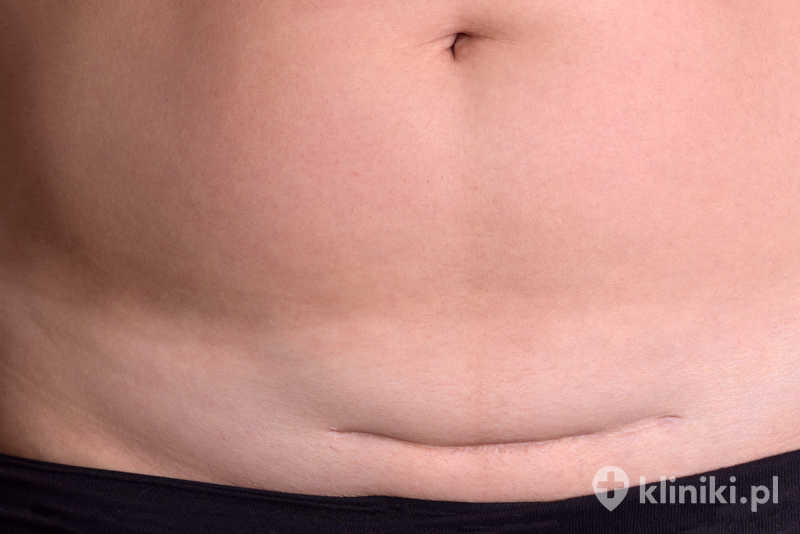 Terapia endometriozy w bliźnie wymaga wcześniejszego potwierdzenia rozpoznania Terapia endometriozy w bliźnie wymaga wcześniejszego potwierdzenia rozpoznania