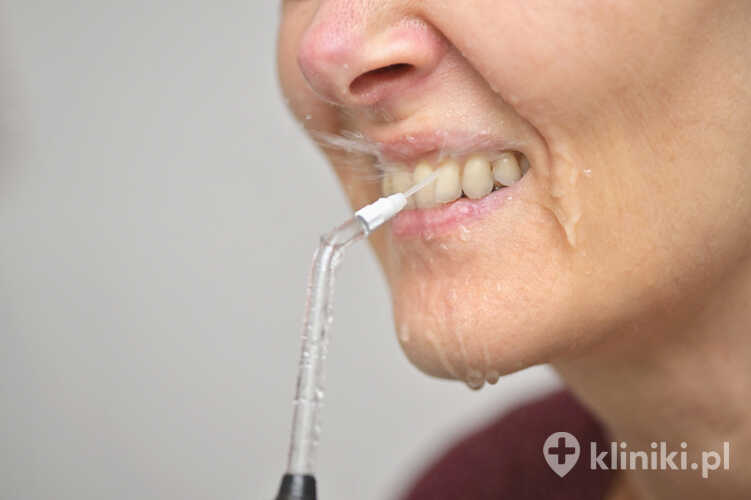 Terapia periodontologiczna pomaga ograniczyć stan zapalny dziąseł