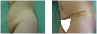 Plastyka ciała (body lifting) przed i po zabiegu