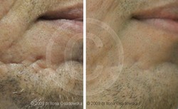 Blizny potrądzikowe na brodzie - usuwanie laserem przed i po zabiegu