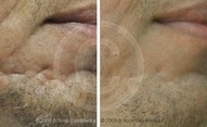 Laserowe usuwanie blizn przed i po zabiegu