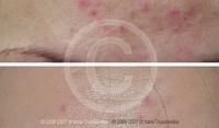 Laserowe usuwanie zmian skórnych przed i po zabiegu