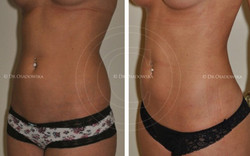 Liposukcja Body Jet - talia przed i po zabiegu