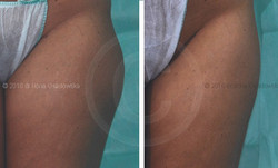 Liposukcja laserowa - uda wewnętrzne przed i po zabiegu