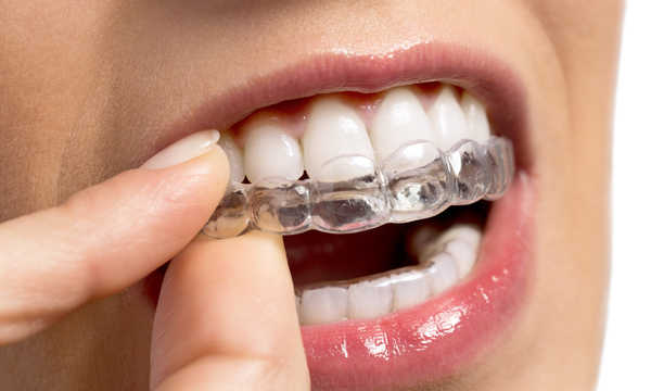 Aparat ortodontyczny Invisalign