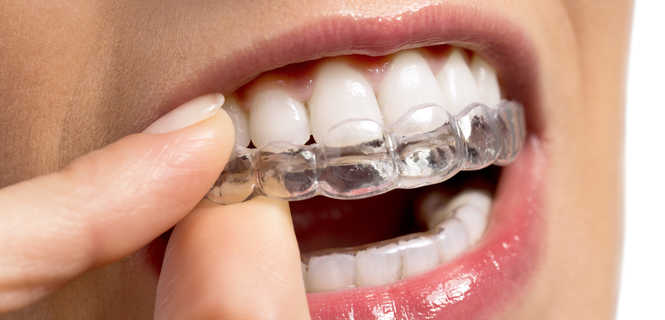 Aparat ortodontyczny Invisalign