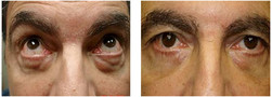 Karboksyterapia - cienie i sińce pod oczami przed i po zabiegu