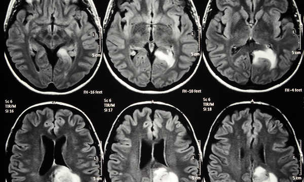 Rezonans magnetyczny głowy