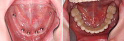 Implanty - przed i po
