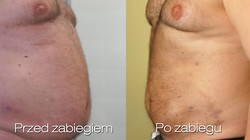 Liposukcja (odsysanie tłuszczu) brzucha - zdjęcie przed i po zabiegu