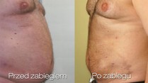 Liposukcja (odsysanie tłuszczu) brzucha - zdjęcie przed i po zabiegu