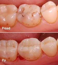 Odbudowa zęba kompozytem - zdjęcie przed i po 