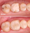 Odbudowa zęba kompozytem - zdjęcie przed i po 