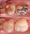 Odbudowa zęba kompozytem - zdjęcie przed i po 
