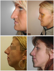 Korekcja nosa - przed i po zabiegu