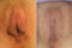 Labioplastyka - zdjęcie przed i po zabiegu