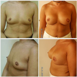 Powiększanie piersi - przed i po