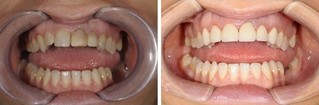 Zdjęcie przed i po zabiegu - wykonano korony pełnoceramiczne oraz wybielanie zębów