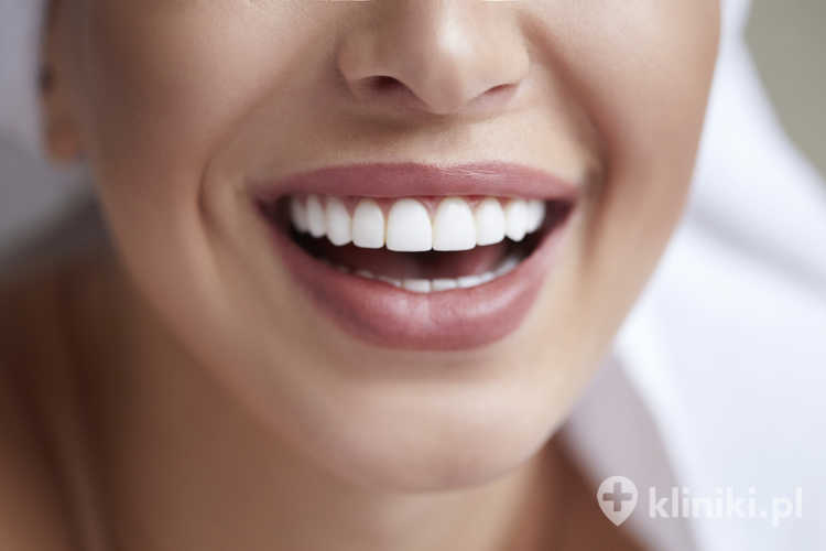 Sposoby wybielania zębów