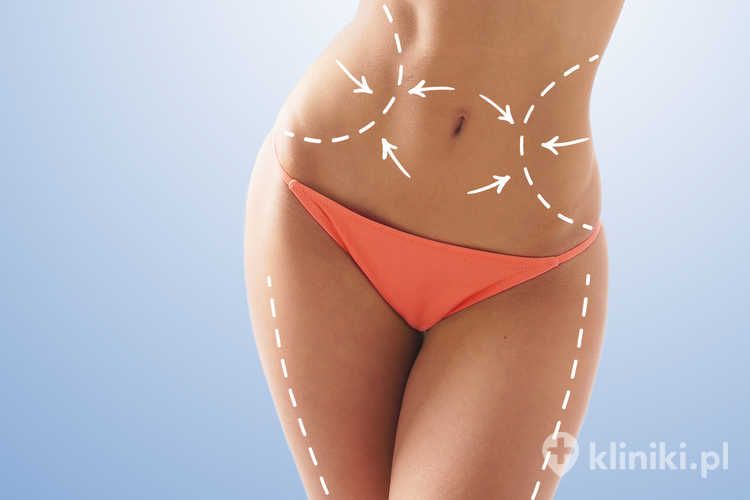 Z liposukcji Vaser Lipo HD korzystają także kobiety