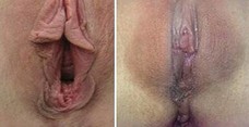 Plastyka warg sromowych - zdjęcie przed i po zabiegu