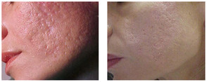 Blizny potrądzikowe na całej twarzy - usuwanie laserem przed i po zabiegu