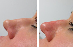 Korekta kształtu nosa kwasem hialuronowym przed i po zabiegu