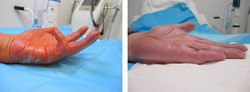 Igłowe przecięcie zmienionego chorobowo rozcięgna dłoniowego w przykurczu Dupuytrena - igłowa aponeurotomia