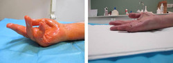 Igłowe przecięcie zmienionego chorobowo rozcięgna dłoniowego w przykurczu Dupuytrena - igłowa aponeurotomia