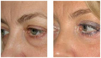 Operacje plastyczne powiek przed i po zabiegu