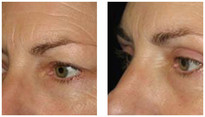 Operacje plastyczne powiek przed i po zabiegu