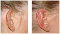 Operacje plastyczne uszu przed i po zabiegu