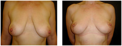 Podniesienie piersi przed i po zabiegu