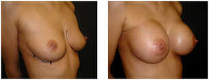 Powiększanie piersi implantami przed i po zabiegu