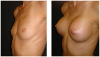 Powiększanie piersi przed i po zabiegu