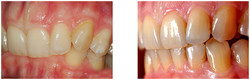 Aparat ortodontyczny przed i po zabiegu