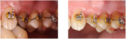 Korekta ustawienia pojedynczego zęba za pomocą aparatu ortodontycznego