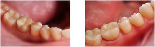 Odbudowa zęba po leczeniu kanałowym za pomocą korony pełnoceramicznej
