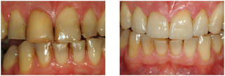 Licówka pełnoceramiczna przed i po zabiegu