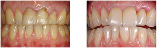 Korekta kształtu zębów za pomocą licówek pełnoceramicznych indywidualnie malowanych