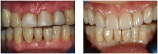 Licówka pełnoceramiczna przed i po zabiegu